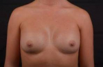 Breast Augmentation - Case #41 After
