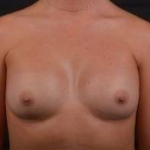 Breast Augmentation - Case #41 After