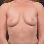 Case 39 Before & After Breast Augmentation | Nashville, TN | Nashville Plastic Surgery Institute Before