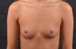 Breast Augmentation Silicone Gel - Case #21 Before