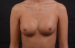 Breast Augmentation Silicone Gel - Case #21 After