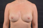 Breast Augmentation Silicone Gel - Case #19 After