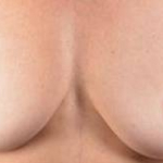 Breast Augmentation Silicone Gel - Case #37 Before