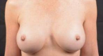 Breast Augmentation Silicone Gel - Case #37 After