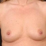 Breast Augmentation Silicone Gel - Case #3 Before