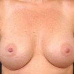 Breast Augmentation Silicone Gel - Case #3 After
