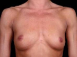Breast Augmentation Silicone Gel - Case #4 Before
