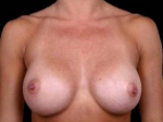 Breast Augmentation Silicone Gel - Case #4 After