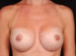 Breast Augmentation Silicone Gel - Case #5 After