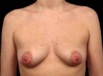 Breast Augmentation Silicone Gel - Case #8 Before
