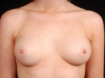 Breast Augmentation Silicone Gel - Case #10 Before