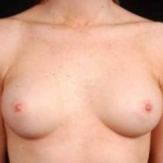 Breast Augmentation Silicone Gel - Case #10 Before
