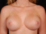 Breast Augmentation Silicone Gel - Case #10 After