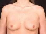 Breast Augmentation Silicone Gel - Case #12 Before