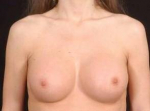 Breast Augmentation Silicone Gel - Case #12 After