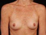 Breast Augmentation Silicone Gel - Case #13 Before