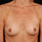 Breast Augmentation Silicone Gel - Case #13 Before