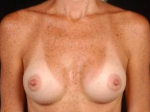 Breast Augmentation Silicone Gel - Case #13 After