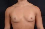 Breast Augmentation Silicone Gel - Case #16 Before