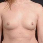 Breast Augmentation Silicone Gel - Case #18 Before