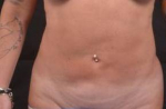 Liposuction - Case #17 Before