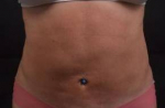 Liposuction - Case #17 After