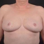 Breast Reduction - Case #21 After
