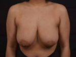 Breast Reduction - Case #20 Before