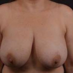 Breast Reduction - Case #17 Before