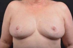 Breast Reduction - Case #16 After
