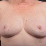 Breast Reduction - Case #16 After