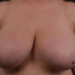 Breast Reduction - Case #15 Before