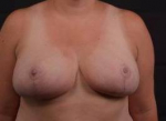 Breast Reduction - Case #15 After
