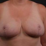 Breast Reduction - Case #15 After