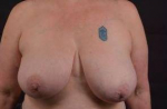 Breast Reduction - Case #14 Before
