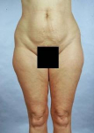 Liposuction - Case #1 Before