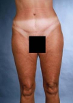 Liposuction - Case #1 After