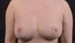 Breast Reduction - Case #13 Before