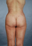Liposuction - Case #3 After