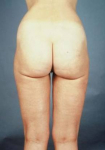 Liposuction - Case #4 After