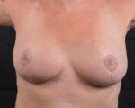Breast Reduction -- Case #11 After