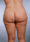 Liposuction - Case #6 After