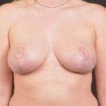 Breast Reduction with Mastopexy - Case #10 After
