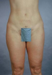 Liposuction - Case #7 After