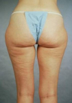 Liposuction - Case #8 Before