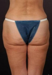 Liposuction - Case #9 Before