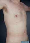 Liposuction - Case #11 After