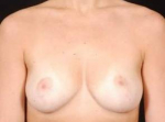 Breast Reduction - Case #1 After