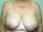 Breast Reduction - Case #2 Before