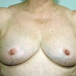 Breast Reduction - Case #2 After